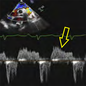RevFlow DesAo (Reversal holodiastolic flow in descending aorta) aortic regurgitation