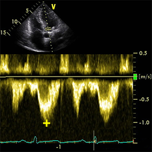 Vmax LVOT (Peak velocity Left ventricular aoutflow tract) PW doppler