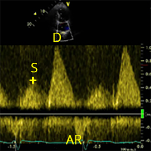 PV S wave (Pulmonary vein peak velocity - Early systole)