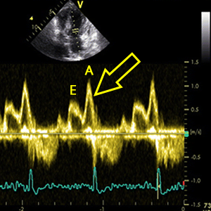Dominant mitral A wave (A wave > E wave)