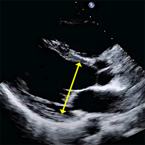 LVIDd (Left ventricular internal dimension at end-diastole)