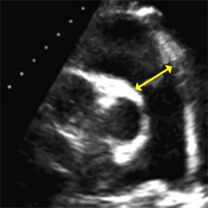 Right ventricular outflow tract dimension at distal