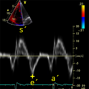 e´ prime wave TV (Peak velocity in early diastole of the tricuspid annulus - TDI)