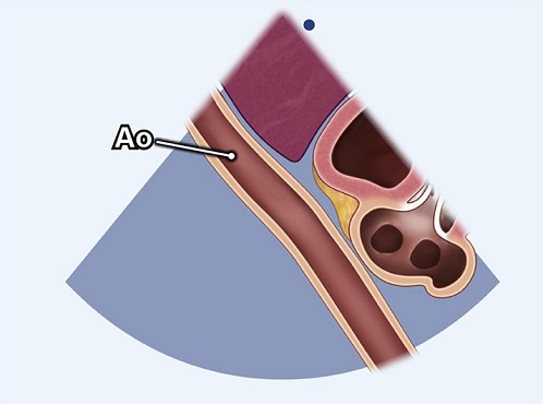 Echocardiography view: SC long axis abdominal aorta, Window: Subcostal window