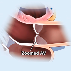echo PLAX view - zoom aortic valve, diastole