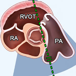 PSAX (level great vessels) focus on branch pulmonary artery, PW doppler