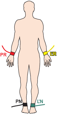 ECG extremity electrodes, left arm (LA), right arm (RA), right leg - neutral, left leg