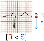 calculating heart axis with negative qrs complex