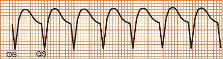 ECG monomorphic ventricular tachycardia, calculation heart rate 150 bpm