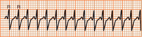ECG supraventricular tachycardia, calculation heart rate 300 bpm