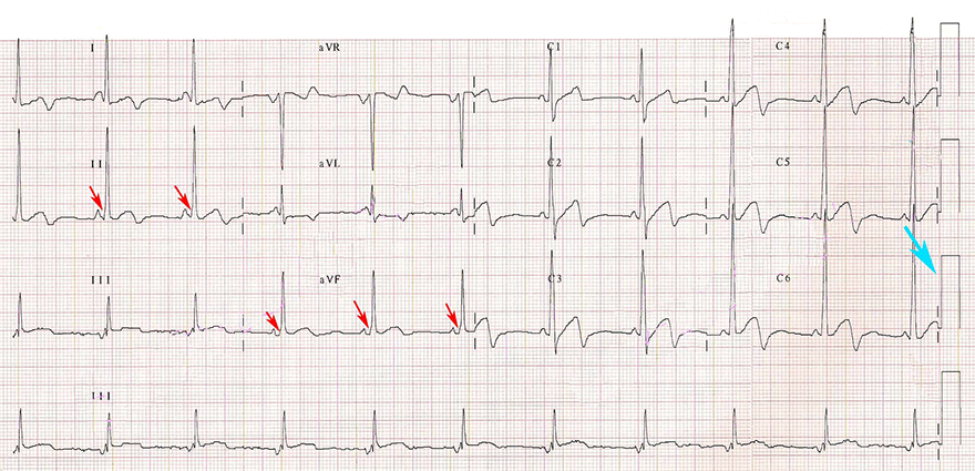 ECG with clearly recognize delta wave after change caligration from 10mm to 20mm