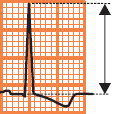 Voltage QRS morphology, amplitude