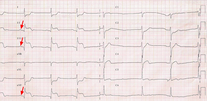 ECG with interatrial (Bachmann) block (type 1) and acute inferior STEMI infarction
