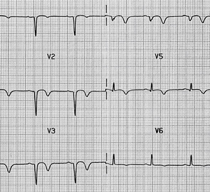 ECG old antero-septal STEMI infarction, pathological Q wave (V1-V3)