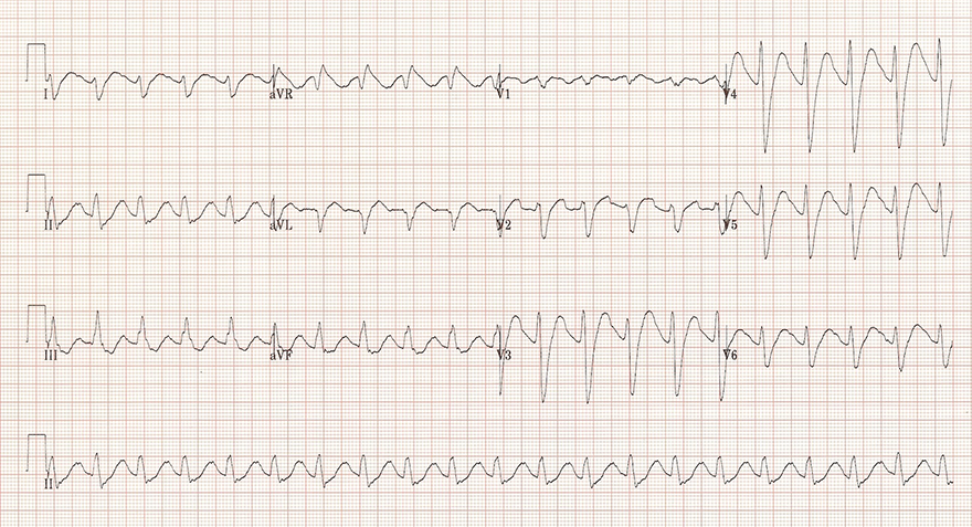 ECG tricyclic antidepressants overdose, side effects, dominant r wave avr lead