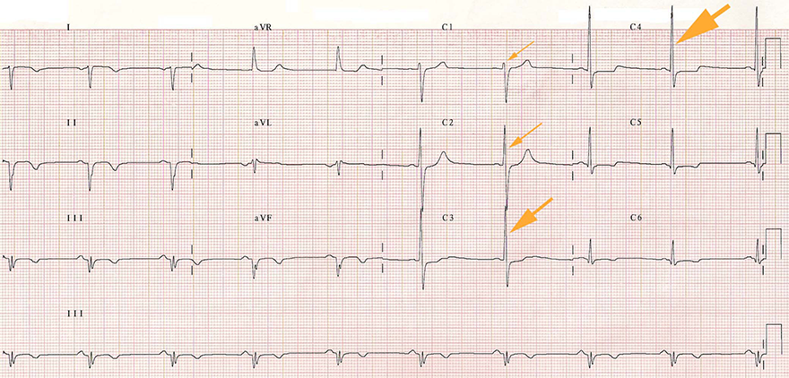 ECG Right sided precordial leads, old inferior stemi, dextrocardia with poor r wave progression