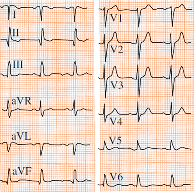 ECG reversal of the left and right arm electrodes, with normal r wave progression