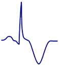 ECG inverted - negative T wave