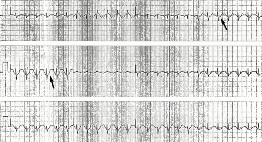 ECG sinus tachycardia, negative - inverted Ta wave
