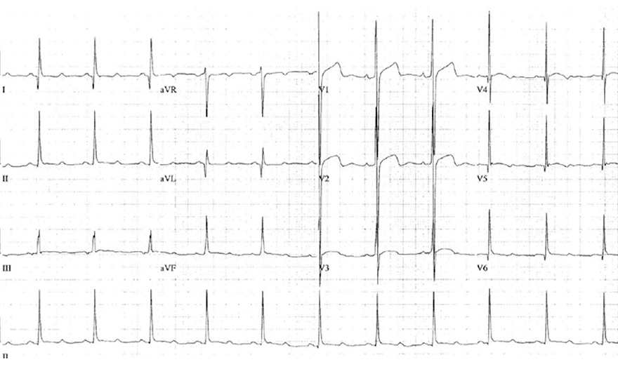 ECG U wave and septal hypertrophic cardiomyopathy