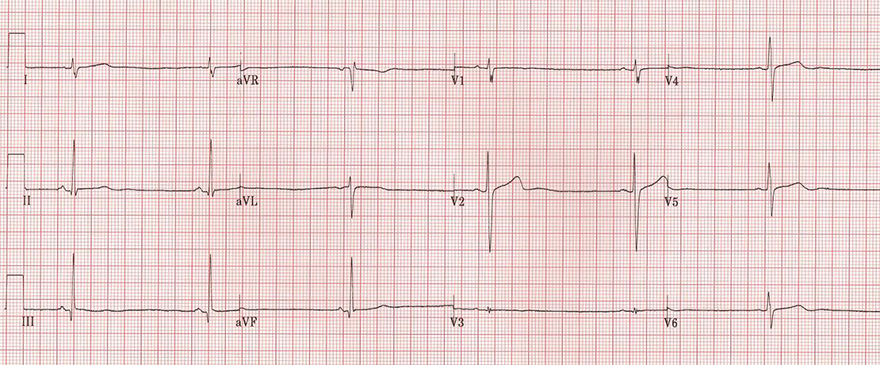 ECG normal U wave and sinus bradycardia