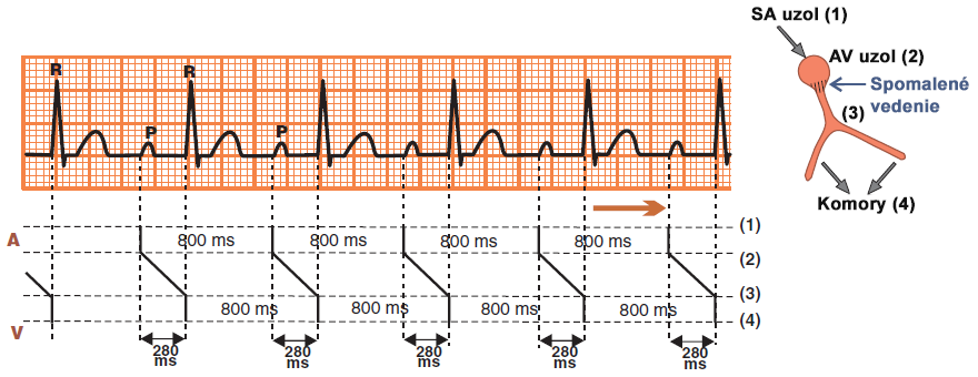 ECG and ladder diagram (laddergram) with first degree av block. Prolonged PQ (PR) interval, delayed conduction through the av node