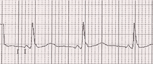 ECG Lown Ganong Levine (LGL) syndrome. Short PQ (PR) interval, normal P wave, normal QRS complex, absent delta wave