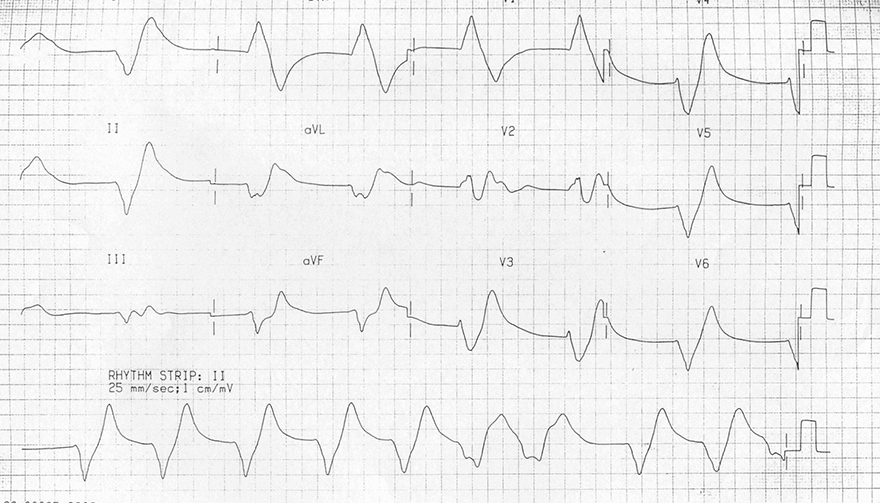 ECG sine wave, hyperkalemia, potassium level 9,9 mEq/L, peaked T waves, broad prolonged QRS complexes