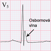 ECG hypothermia osborn J wave