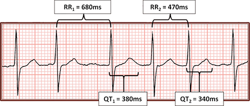 ECG atrial fibrillation, long QT interval, corrected QT interval calculation