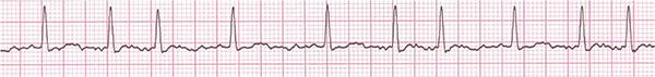 ECG atrial fibrillation, irregular rhythm
