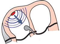 Ectopic pacemaker sa node focus