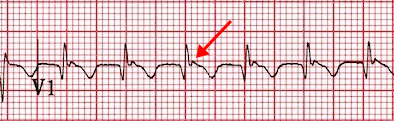 ECG Pseudo r wave, V1, AV Nodal Re-entry Tachycardia (AVNRT)