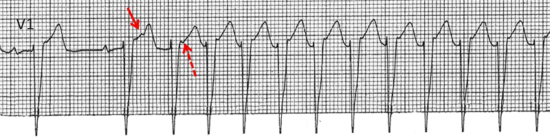 ECG (V1) sinus rhythm, premature atrial complex, AVNRT, pseudo R wave