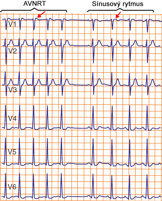 ECG typical (slow fast) AVNRT vs. Sinus rhythm, pseudo R wave (V1)