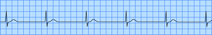 ECG junctional av escape rhythm, junctional rhythm at a rate of 40-60 bpm
