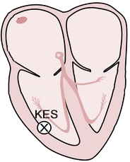 ventricular ectopic, and premature ventricular complex