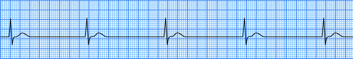 ECG atrioventricular av nodal bradycardia