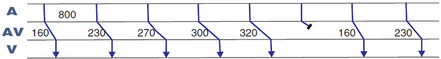 Laddergram, second degree av block wenckebach, 6:5