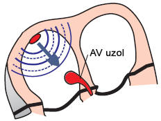 atrioventricular junction conduction