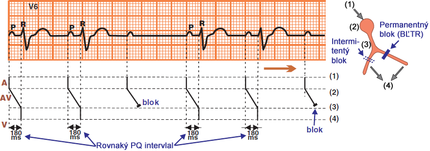 ECG, Laddergram, 2nd degree AV block, Mobitz II, broad QRS complex
