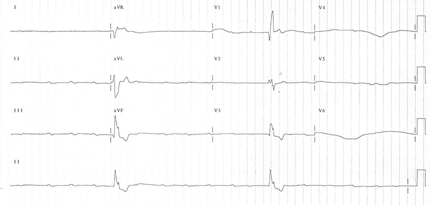 ECG complete AV block, av dissociation, broad QRS