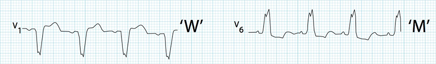 ECG complete LBBB, Broad QRS, Dominant S wave (V1), Notched dominant R wave (V6), absence of Q wave (V6)