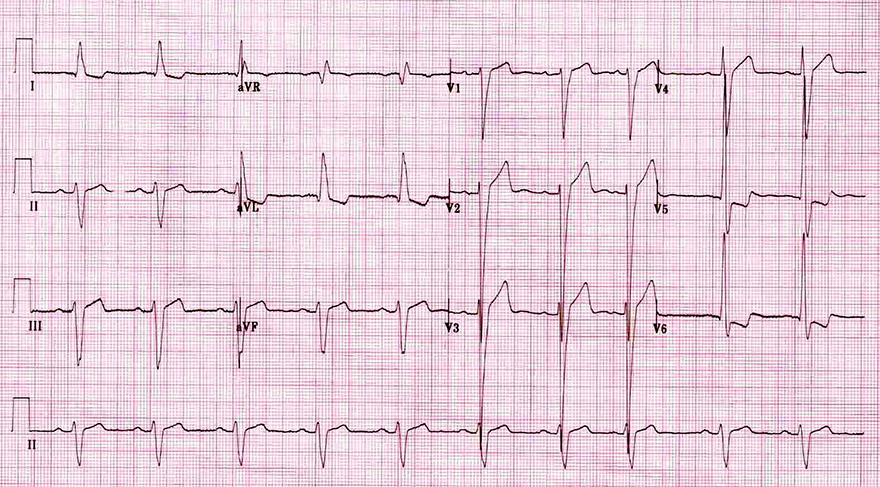 ECG left ventricular hypertrophy, huge precordial R and S waves, LV strain pattern, ST elevation V1-V3, Left axis deviation
