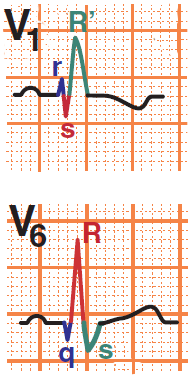 ECG Right Bundle Branch Block (RBBB), Broad QRS, rsR pattern (V1-V3), wide slurret s wave (V6),  