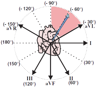 Left axis deviation, frontal plane, left anterior hemiblock