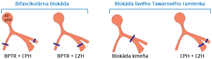 Bifascicular block (RBBB, LPH, LAH), LBBB