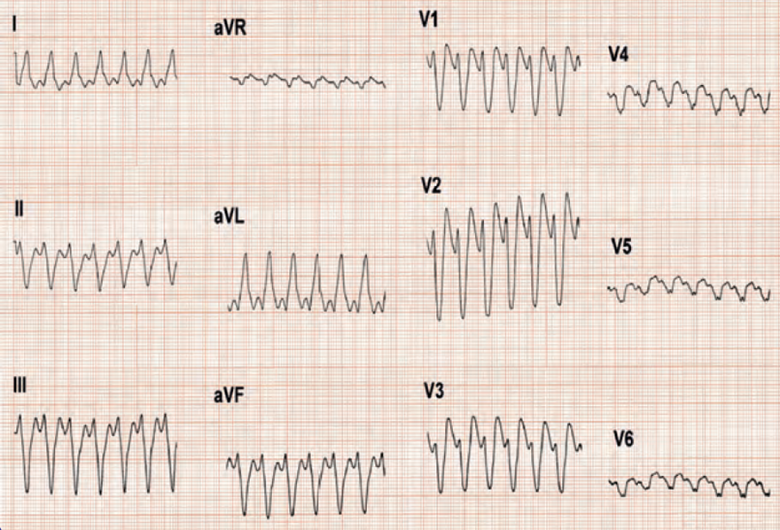 ECG ventricular tachycardia (wide complex tachycardia), LBBB morphology, initial R wave V1 30ms