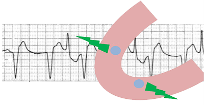 ECG polymorphic ventricular tachycardia bifocal, Bidirectional ventricular tachycardia 