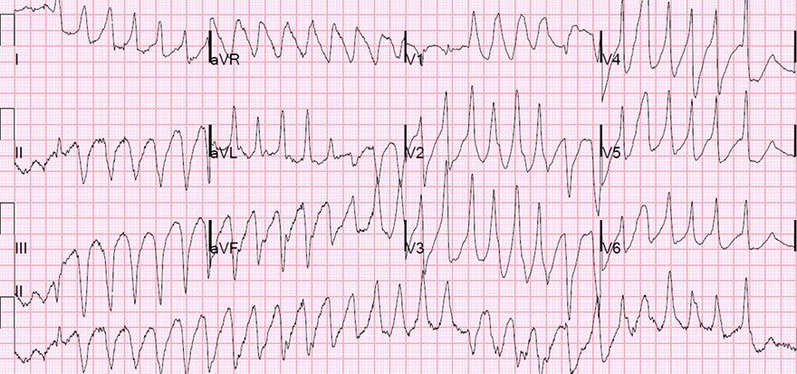 ECG polymorphic VT after inferior STEMI infarction, AV dissociation